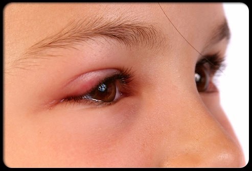 症状  :眼红     红眼病的标志性症状是眼睛发红,但很少会导致长期
